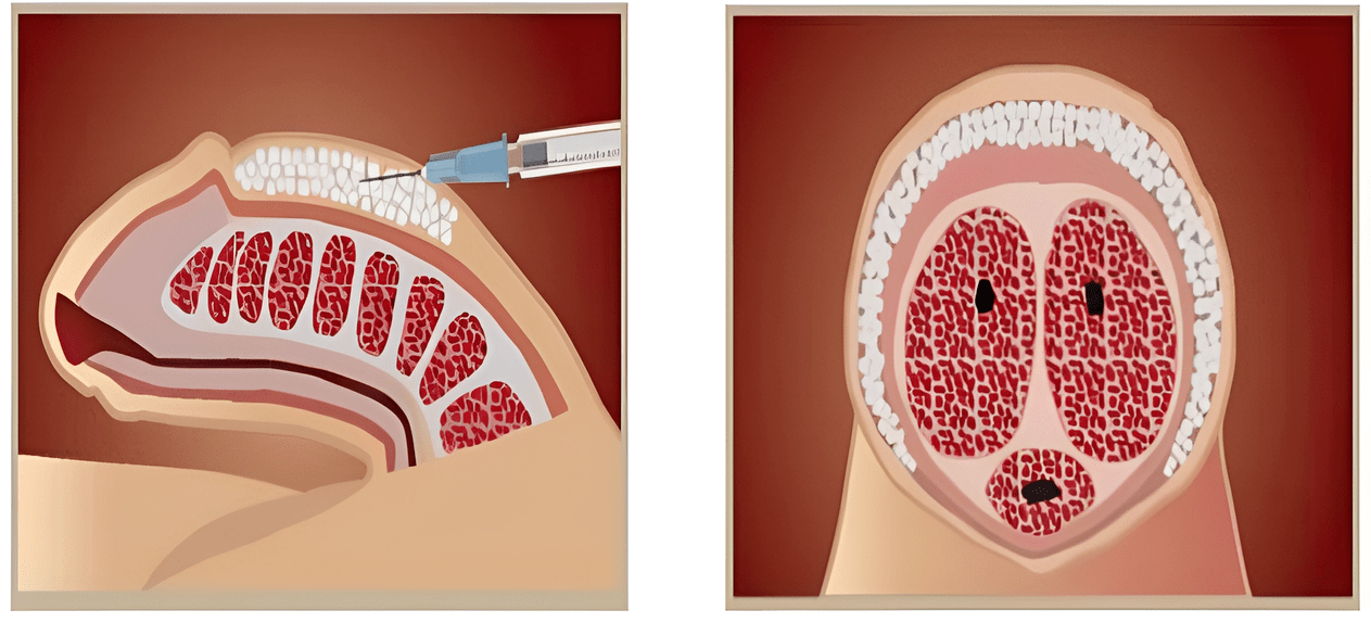filler injection areas